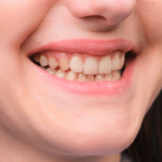 Coffee Stained Teeth