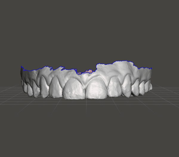 Replacement Retainers From STL Files