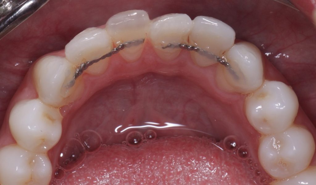 An example of a broken wire retainer